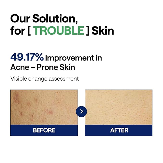 MEDIHEAL Teatree Trouble Facial Toner Pads with Tea Tree & Lactobacillus - Calming & Soothing for Sensitive & Acne Prone Skin - Vegan Face Gauze, 100 Pads