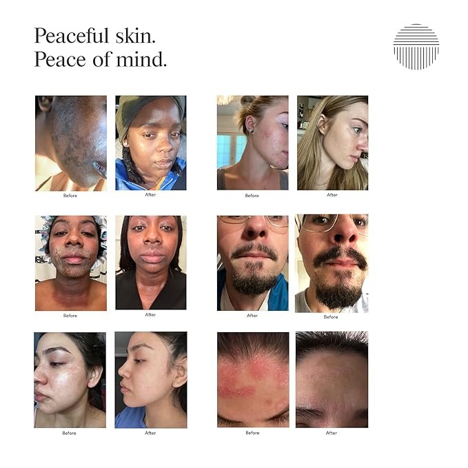 Dermazen Calming Seborrheic Serum, Dermatologist Recommended, Topical Serum For Hair, Face, and Body (4oz)