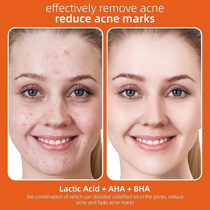 Acne Treatment for Face, Salicylic Acid Serum, Skin Care Essence for Acne, Blackhead, Sebum, Pore, Even out Skin Tone, 1.1fl.oz/30ml