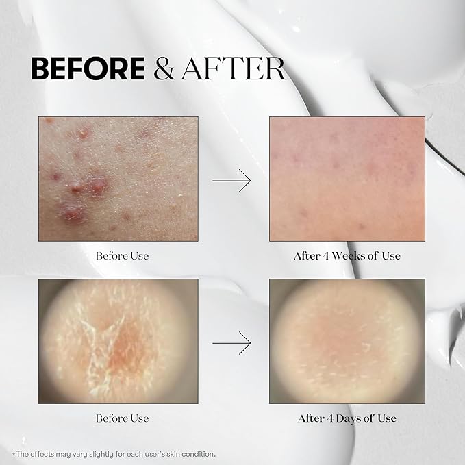 VT COSMETICS Reedle Shot Compact Set, Microneedling Serum Gift Set with Reedle Shot 100, 300, 700, Exfoliating, Anti-Aging, Travel Size Skincare for Women (0.34 oz / 10ml Each)