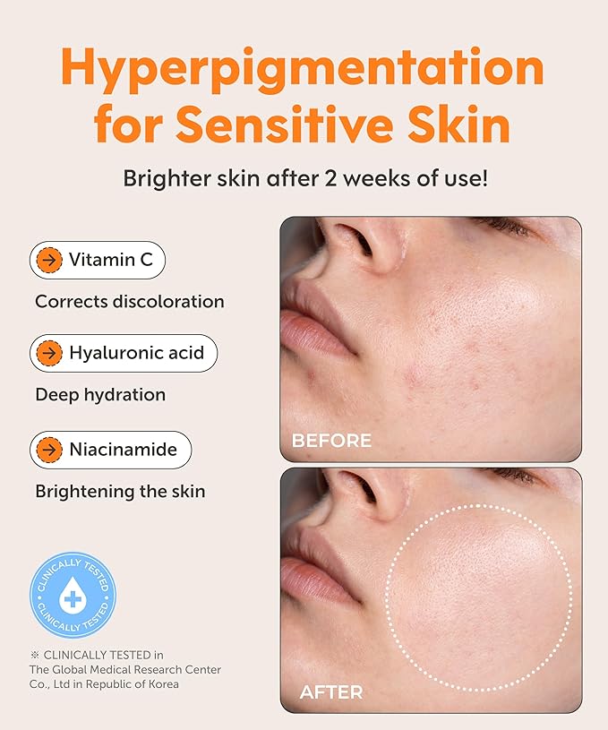 SERUMKIND Vitamin C Serum for Face Korean Skincare – Brightening for Dark Spots, Pore Refining, Discoloration Correcting – With Niacinamide – Reduces Fine Lines and Wrinkles