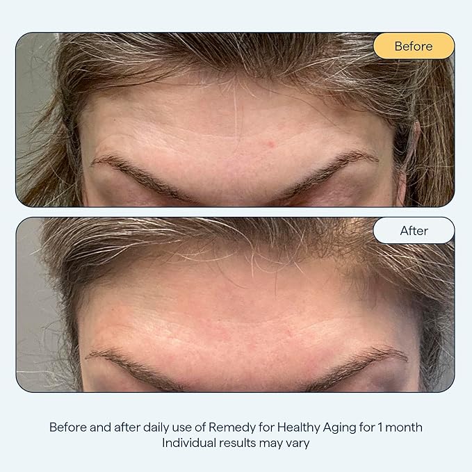 Remedy for Healthy Aging - Retinaldehyde, Resveratrol, Glycolic Acid, Argireline, Ferulic Acid, Matrixyl 3000 - Anti-Aging Treatment for Wrinkles, Uneven Texture & Tone - By Dermatologist Dr. Shah