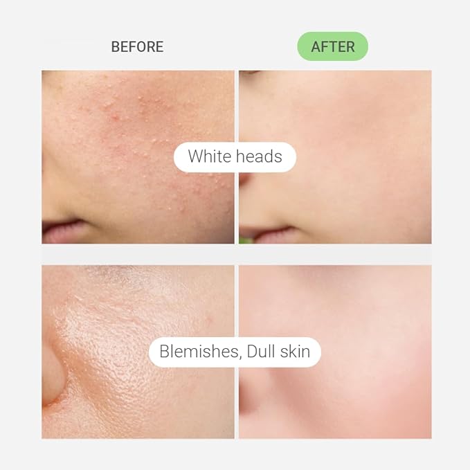 TENZERO CICA Bubble Toner, 4.73 fl oz/140ml, Hydrating & Soothing Centella Toner for Face, Barrier Repair, Korean Bubble Skincare