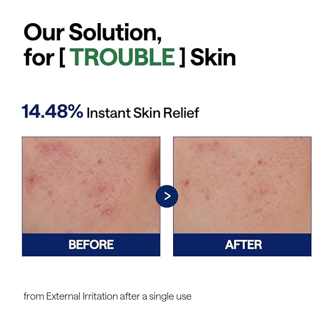 Mediheal Teatree Calming Serum 1.35 fl.oz - Quick Skin Calming and Redness Relief - Sebum Care, Oil Moisture Balance & Deep Moisturization with Hyaluronic Acid