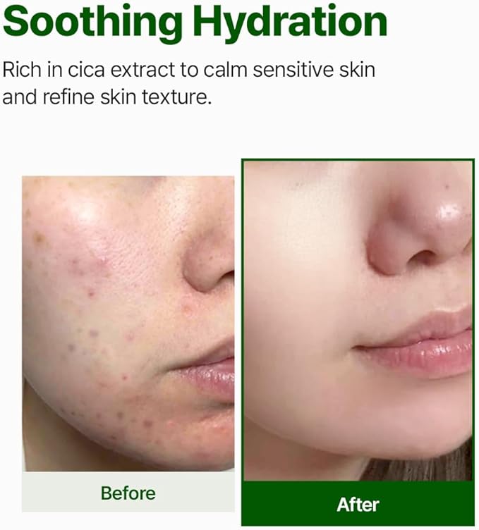 NACIFIC CICA PDRN First Toner 5.07 fl oz 150ml – Centella Asiatica & PDRN for Sensitive Skin, Cooling Spot Toner, Balancing & Soothing Korean Skincare