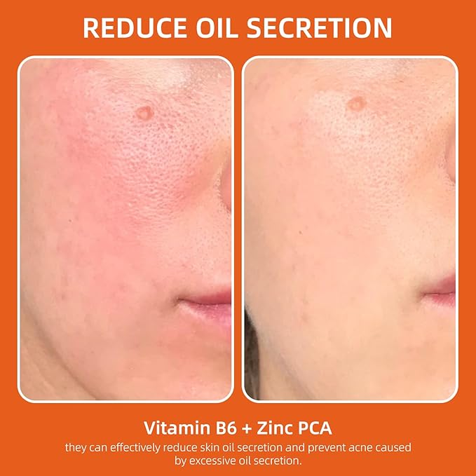 Acne Treatment for Face, Salicylic Acid Serum, Skin Care Essence for Acne, Blackhead, Sebum, Pore, Even out Skin Tone, 1.1fl.oz/30ml