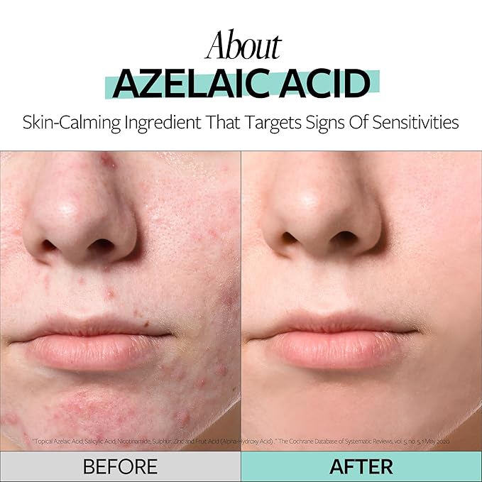 RECIPE Azelaic Acid 10 Soothing Ampoule - Soothing Serum, Facial Serum for Sensitive skin - Korean Skincare for Mild Breakouts (1.01 fl oz)