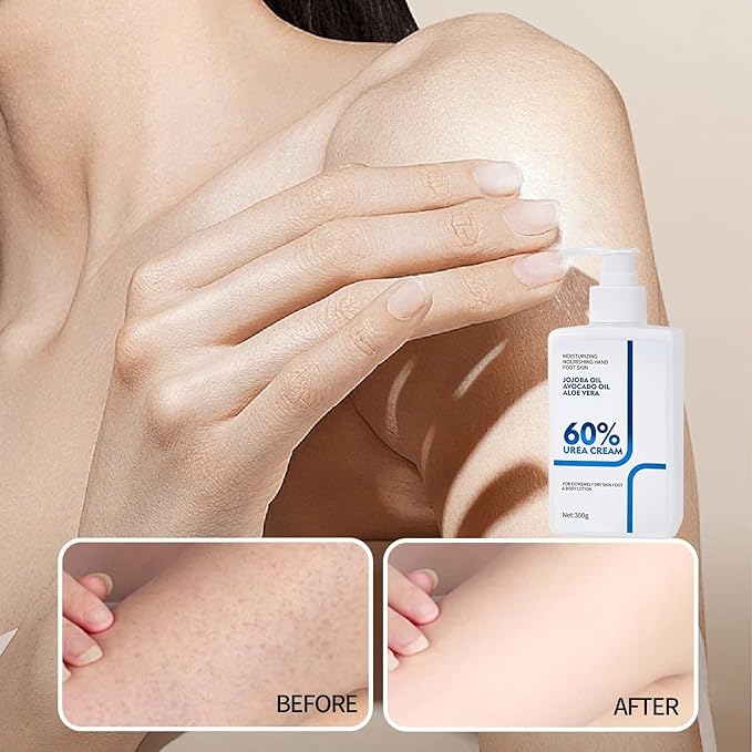 Urea Cream 60 Percent Body Lotion 10.58 Oz, Body Lotion for Dry Skin, Skin Moisturizing Lotion for Extremely Dry Skin, Non Greasy Body Cream