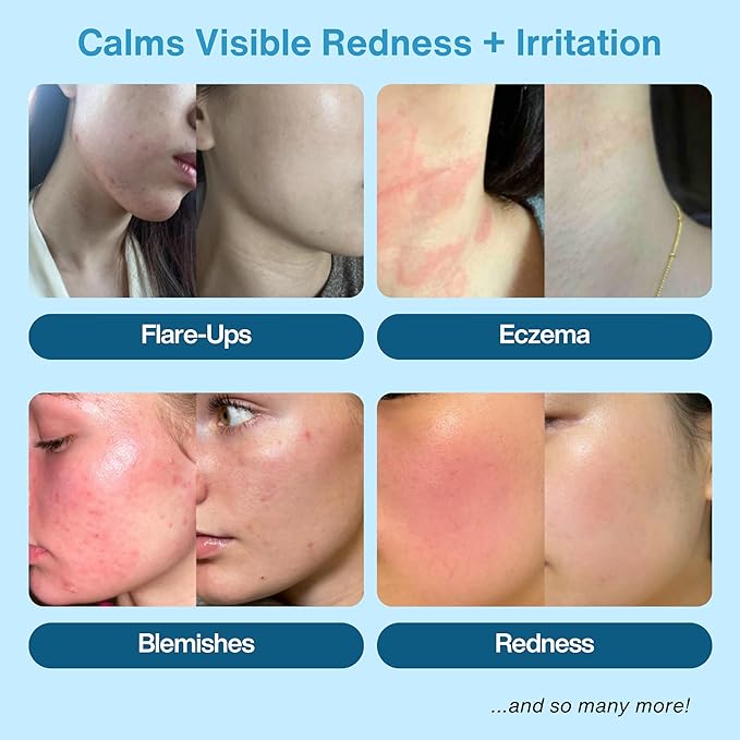 Honeydew Labs Hypochlorous Acid Spray – HOCl Face & Body Mist for Acne, Eczema & Irritation – Multi-Purpose Skin Repair – Eyelid Cleanser, Post-Workout/Procedure, Scalp & Sensitive Skin (2 oz+6.8 oz)