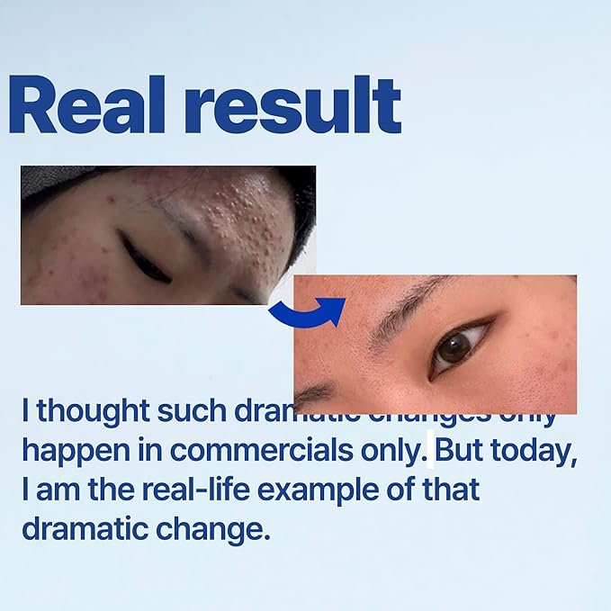 ISOI ACNI Dr. 1st Control Toner, Plant-Based Soothing Acne Toner for Face, for Oily & Sensitive Skin, Total Sebum Care & Refreshing Hydration with Cooling Effect, Korean Skin Care (4.39 fl.oz/130ml)